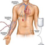 Vascular Access for CKD Patients